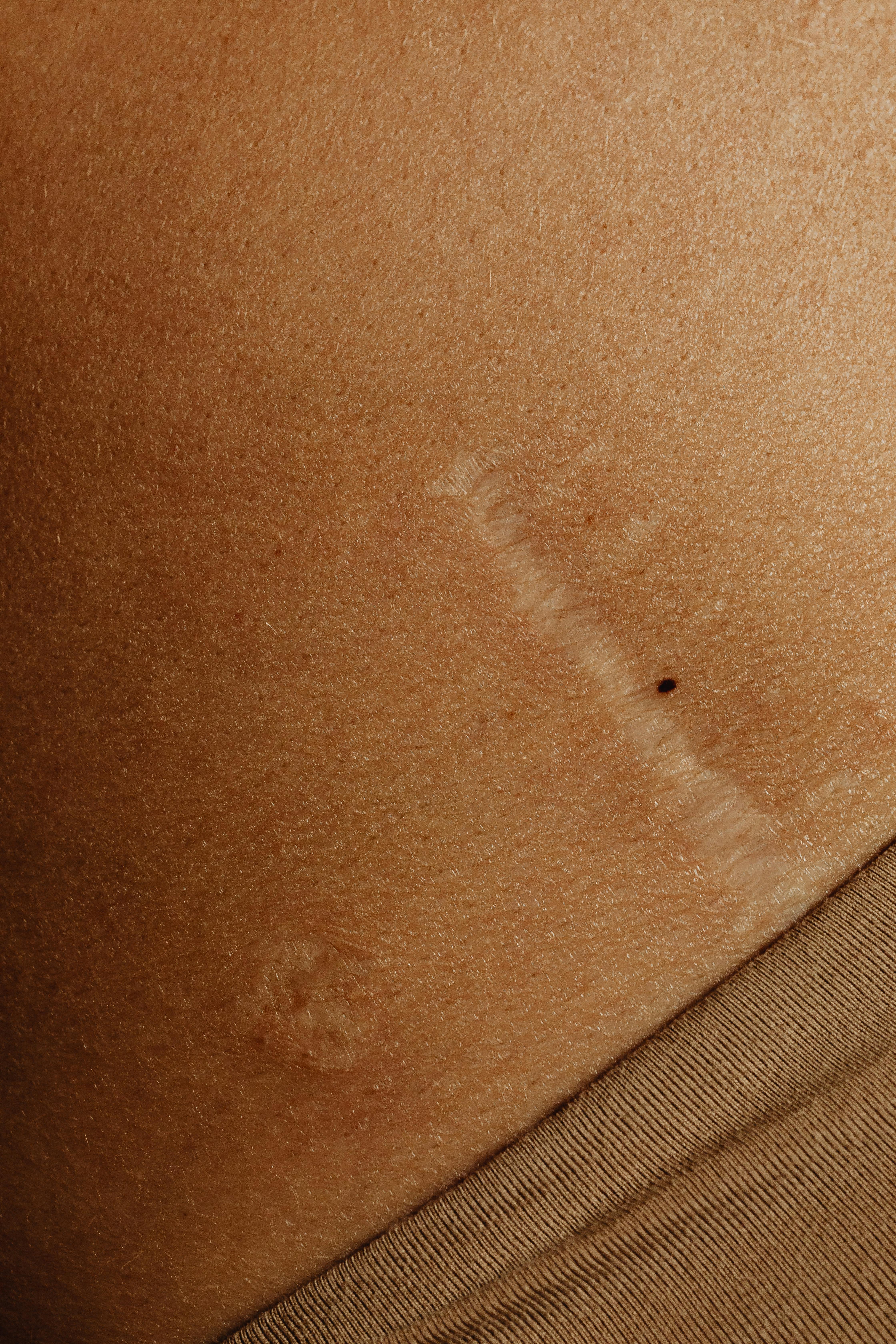 Accidental Scars
